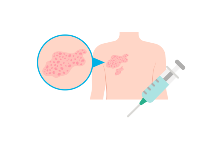 vaccinatie gordelroos